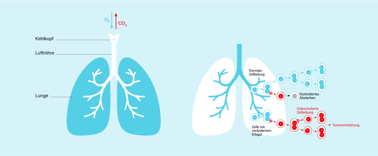 01-01-Was-ist-Lungenkrebs-Section-10.png