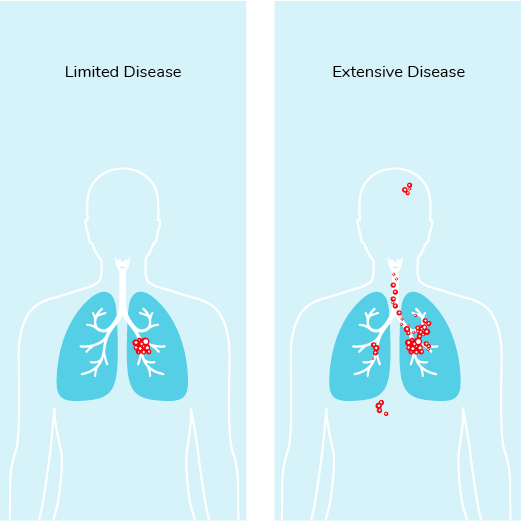 01-02-Section-10_Limited_Disease_Extensive_Disease.png