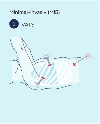 lungenkrebs_hub.behandlung.operation.2024.acc3.1.png