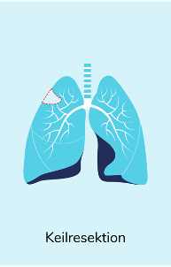 lungenkrebs_hub.behandlung.operation.2024.slider-content.slider1.png