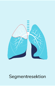 lungenkrebs_hub.behandlung.operation.2024.slider-content.slider2.hz.col1.png